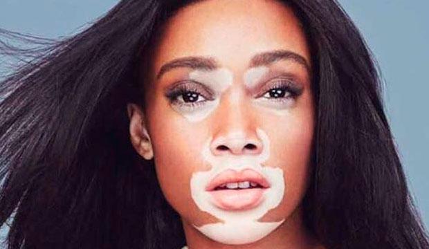 Uma modelo com vitiligo triunfa na passarela-0